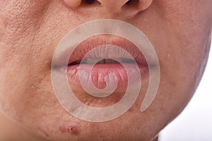 Skin problem with acne diseases, Close up woman face with dry lip mouth