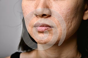 Skin problem with acne diseases, Close up woman face with dry lip mouth.