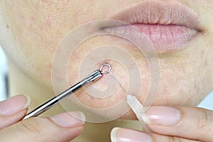 Skin problem with acne diseases, Close up woman face squeezing whitehead pimples on chin with acne removal tool.