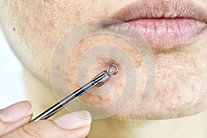 Skin problem with acne diseases, Close up woman face squeezing whitehead pimples on chin with acne removal tool. photo