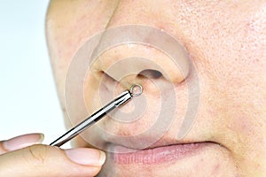 Skin problem with acne diseases, Close up woman face squeezing whitehead pimples on nose with acne removal tool photo