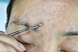 Skin problem with acne diseases, Close up woman face squeezing whitehead pimples with acne removal tool. photo