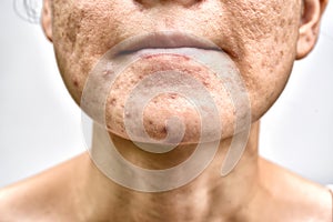 Skin problem with acne diseases, Close up woman face with whitehead pimples on chin, Menstruation breakout.