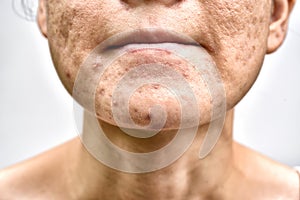 Skin problem with acne diseases, Close up woman face with whitehead pimples on chin, Menstruation breakout. photo