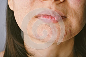 Skin problem with acne diseases, Close up woman face with whitehead pimples on chin photo