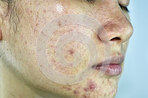 Skin problem with acne diseases, Close up woman face with whitehead pimples, Menstruation breakout.