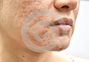 Skin problem with acne diseases, Close up woman face with whitehead pimples, Menstruation breakout, Scar and oily greasy face.