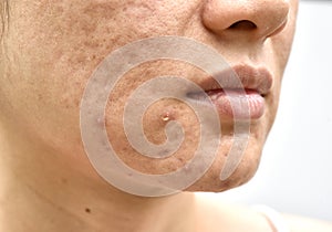 Skin problem with acne diseases, Close up woman face with whitehead pimples, Menstruation breakout, Scar and oily greasy face. photo