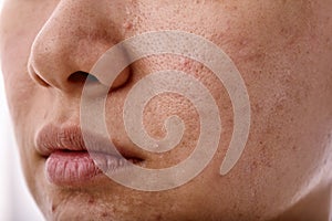 Skin problem with acne diseases, Close up woman face with whitehead pimples on mouth. photo