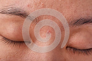 Skin problem with acne diseases, Close up woman face with whitehead pimples on nose.