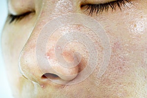 Skin problem with acne diseases, Close up woman wrinkle face with whitehead pimples on nose photo