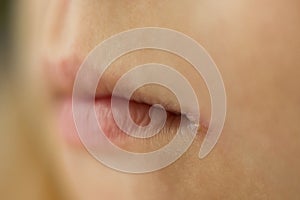 Skin problems, angulitis, angular stomatitis, angular cheilitis  a disease of the mucous membrane photo