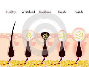 Skin problems. Types of acne pimples. Facial treatments and problem vector illustration. Whiteheads and Blackheads
