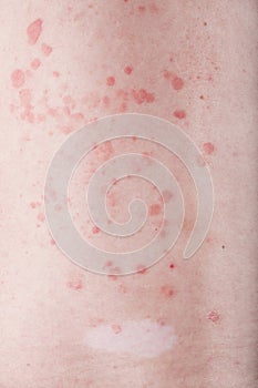 Skin with psoriasis