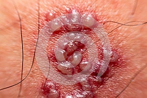 Skin rash and blisters on body. Shingles on men herpes zoster