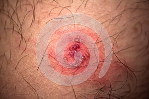 Skin rash and blisters on body. Shingles on men herpes zoster