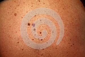 Skin rash skin cancer skin wart