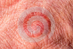 Skin with rash / eczema