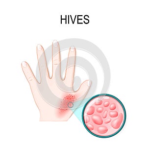 Skin rash. Hives or urticaria. photo