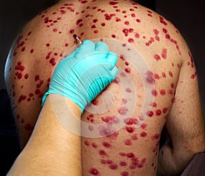 skin rash treatment on male body. Shingles, Disease, Herpes zoster, varicella-zoster virus