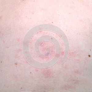 skin rash treatment on woman body.