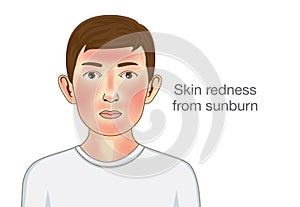 Skin redness appear on facial and neck of kid from sunburn.