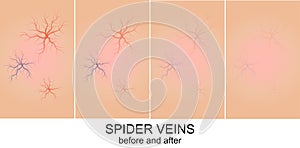 Skin with spider veins