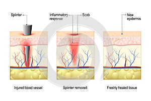 Skin with splinter and wound healing.