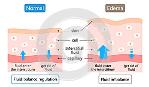 Diagram of edema and normal skin. swelling is caused by excess fluid within the tissues of the body. Before after illustration. photo