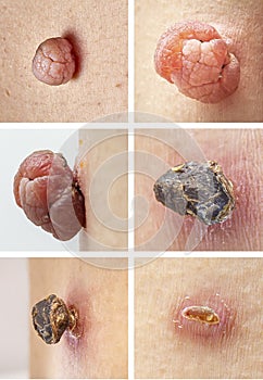 Skin tag mole removal process