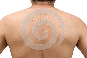 Skin tags or Seborrheic Keratosis on back