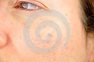 Skin of woman with blemish and spots