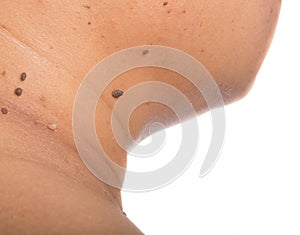 Skin of a woman with moles