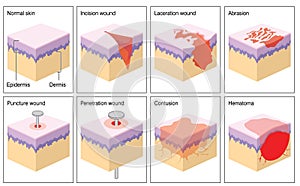 Skin wounds