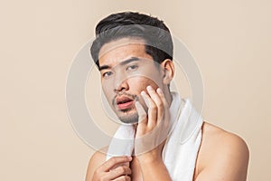 Asian man worry have blemish on face caused by acne photo