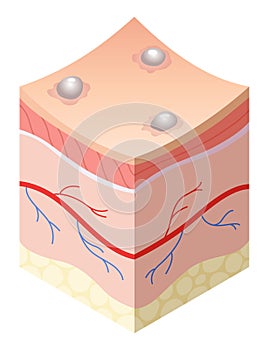 Skincare medical concept. Problems in cross-section of human skin horizontal layers structure. Anatomy illustrative