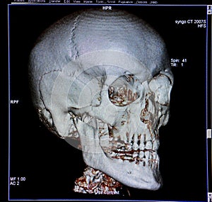 Skull, CT-scan reconstruction, anatomy