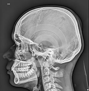 Skull-head medical Xray