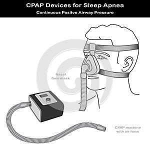 Sleep Apnea, CPAP, Nose Mask