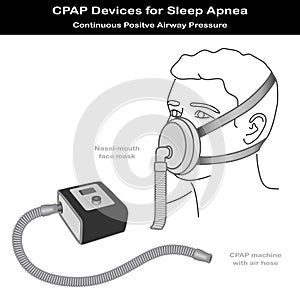 Sleep Apnea, CPAP, Nose - mouth Mask