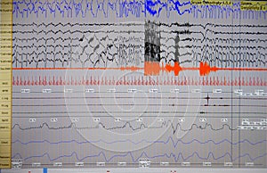 Sleep Apnea Study Computer Reading