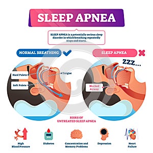 Sleep apnea vector illustration. Labeled nasal tongue blocked airway scheme