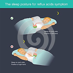 The sleep posture for reflux acids symptom