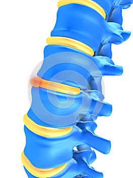 Slipped disc