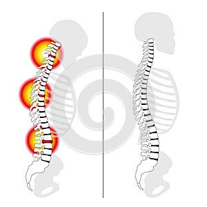 Él resbaló desct ruptura dolor columna vertebral 