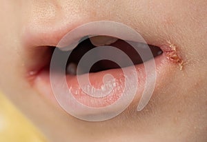 slit-like impetigo in a little girl in the corners of her mouth. Skin wounds. Dermatological bacterial disease. Sticky