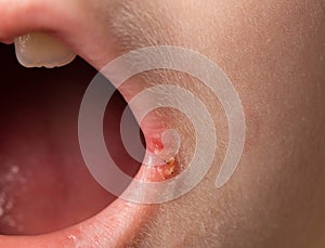 slit-like impetigo in a little girl in the corners of her mouth. Skin wounds. Dermatological bacterial disease. Sticky