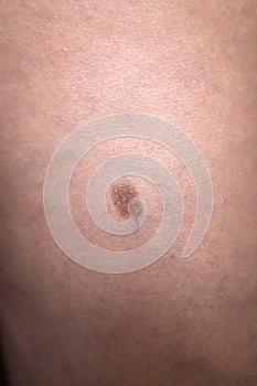 A small birthmark on human skin.