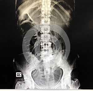 Small bowel obstruction