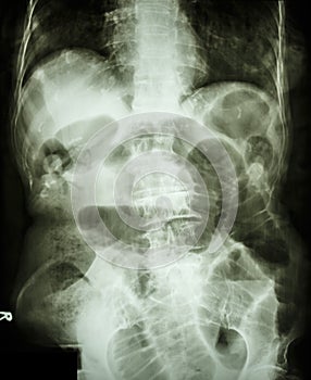 Small bowel obstruction